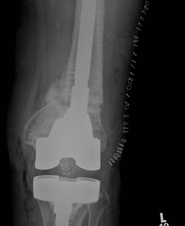 Periprosthetic TKR Locking Plate Nonunion 5